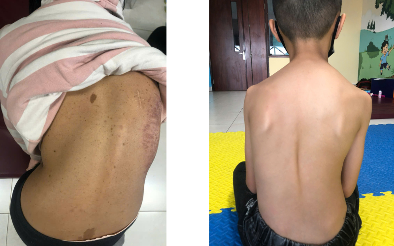 cong vẹo cột sống