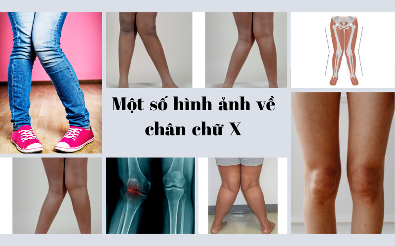 chân chữ x