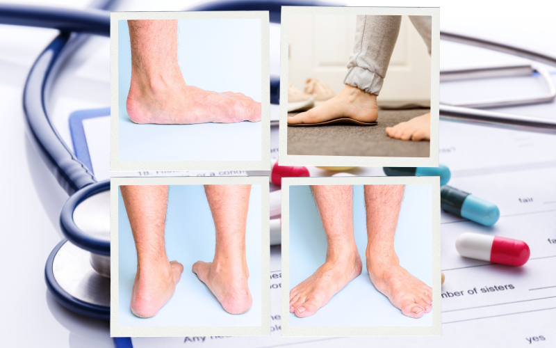 Điều trị bàn chân bẹt